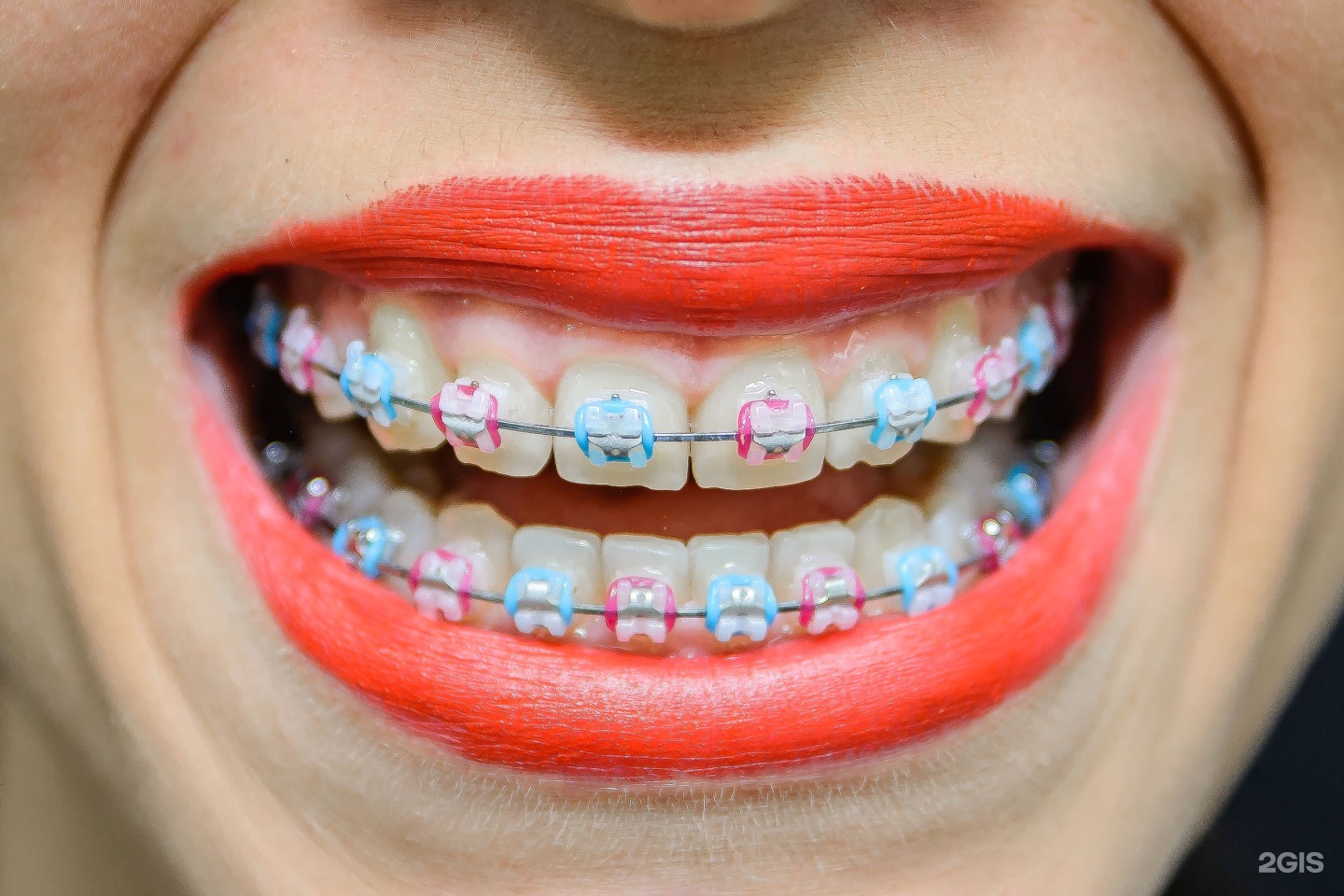 Брекеты на зубы для детей сколько стоят. Брекеты Ортос. Металлические брекеты Orthos. Пластиковые брекеты. Детские керамические брекеты.